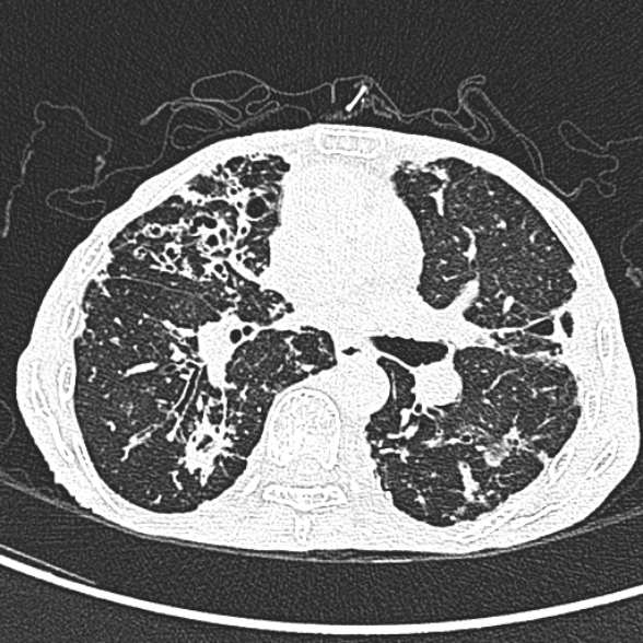 Aspergilloma- with Monod sign (Radiopaedia 44737-48532 Axial lung window 131).jpg