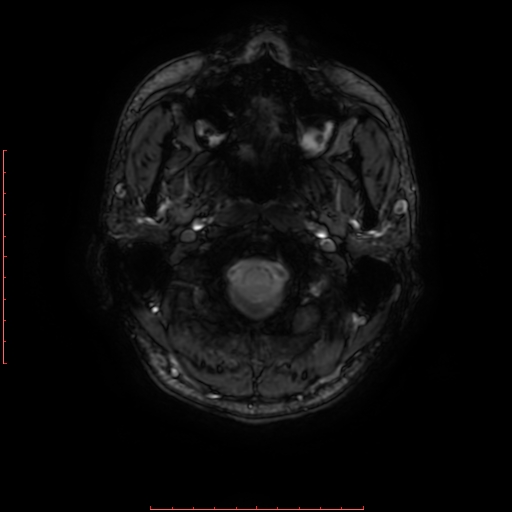 Astrocytoma NOS - cystic (Radiopaedia 59089-66384 Axial SWI 1).jpg