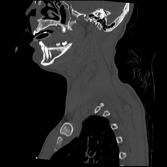 Atlanto-occipital dissociation (Traynelis type 1), C2 teardrop fracture, C6-7 facet joint dislocation (Radiopaedia 87655-104061 Sagittal bone window 16).jpg