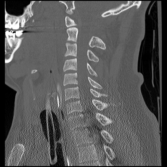 File:Atlanto-occipital dissociation injury (Radiopaedia 29274-29698 Sagittal bone window 32).png