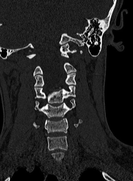 Atlantoaxial subluxation (Radiopaedia 44681-48450 Coronal bone window 66).jpg
