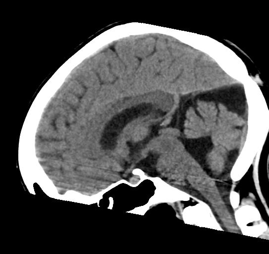 File:Atretic encephalocoele with inferior vermis hypoplasia (Radiopaedia 30443-31107 C 15).jpg