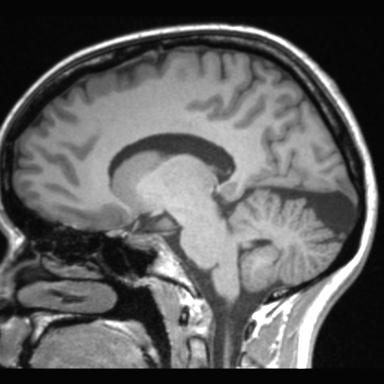 File:Atretic encephalocoele with inferior vermis hypoplasia (Radiopaedia 30443-31108 Sagittal T1 75).jpg