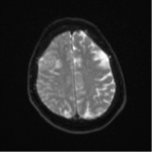 Atypical meningioma (WHO Grade II) (Radiopaedia 54742-60979 Axial DWI 21).png