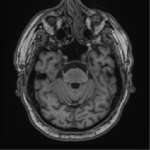 File:Atypical meningioma (WHO grade II) with brain invasion (Radiopaedia 57767-64729 Axial T1 14).png