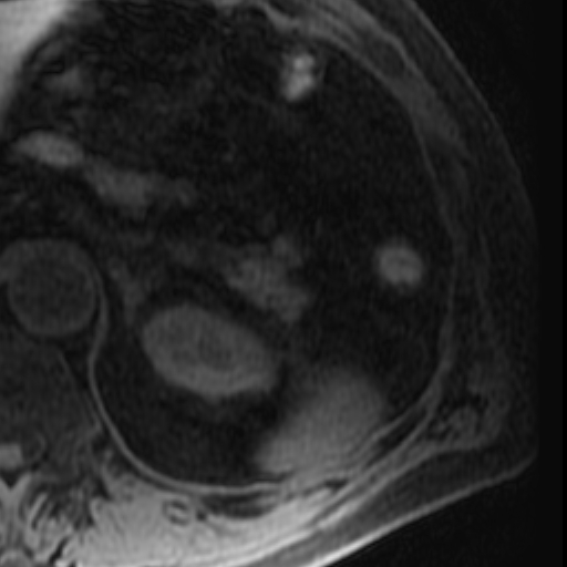 File:Atypical renal cyst on MRI (Radiopaedia 17349-17046 Axial T1 fat sat 5).jpg