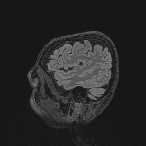Autoimmune limbic encephalitis (Radiopaedia 30363-31005 Sagittal FLAIR 126).jpg