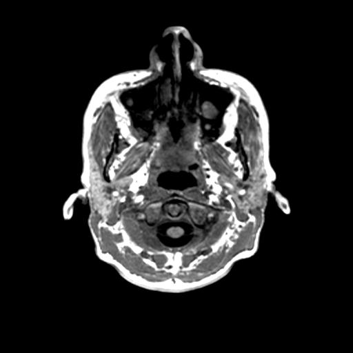 File:Autoimmune limbic encephalitis (Radiopaedia 30363-31005 T1 Axial 1mm 4).jpg