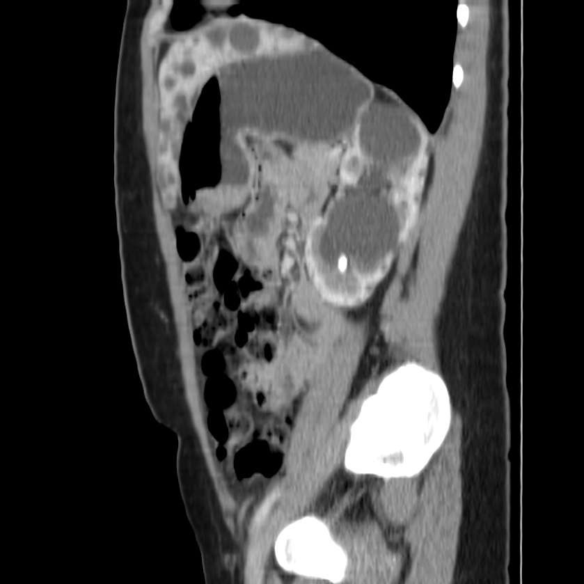 Autosomal dominant polycystic kidney disease (Radiopaedia 23061-23093 F 39).jpg