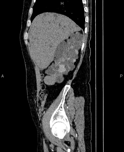 Autosomal dominant polycystic kidney disease (Radiopaedia 87830-104287 C 15).jpg