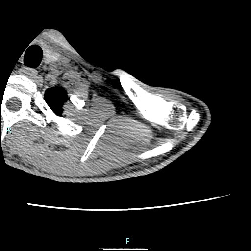 File:Avascular necrosis after fracture dislocations of the proximal humerus (Radiopaedia 88078-104653 D 15).jpg