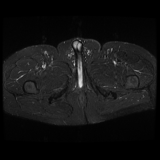 File:Avascular necrosis of the hip (Radiopaedia 61503-69465 Axial STIR 28).jpg