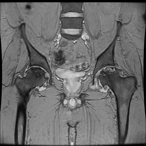 Avascular necrosis of the hip (Radiopaedia 61503-69465 F 46).jpg