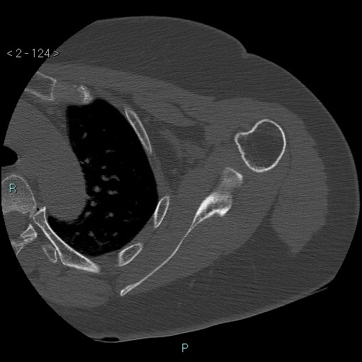 Avascular necrosis of the shoulder - Cruess stage I (Radiopaedia 77674-89887 Axial bone window 31).jpg