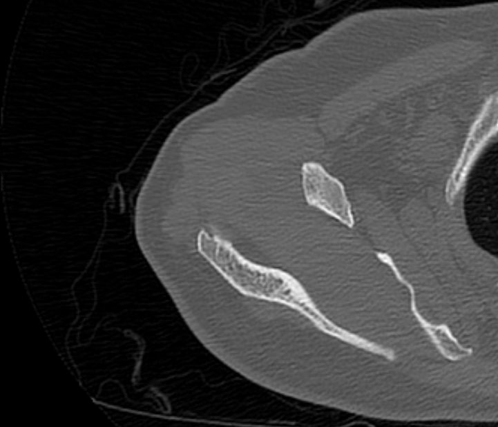 Avulsion fracture - greater tuberosity of humerus (Radiopaedia 71216-81514 Axial bone window 21).jpg