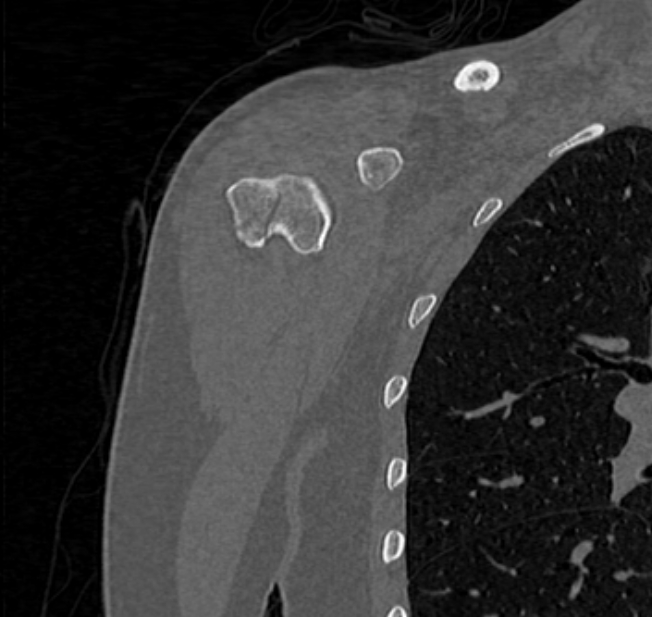 Avulsion fracture - greater tuberosity of humerus (Radiopaedia 71216-81514 Coronal bone window 7).jpg