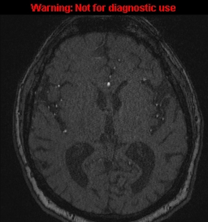 Azygos anterior cerebral artery (Radiopaedia 59325-66677 Axial MRA 90).jpg