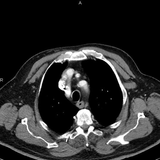 File:Azygos continuation of the inferior vena cava (Radiopaedia 18537-18404 C+ arterial phase 14).jpg
