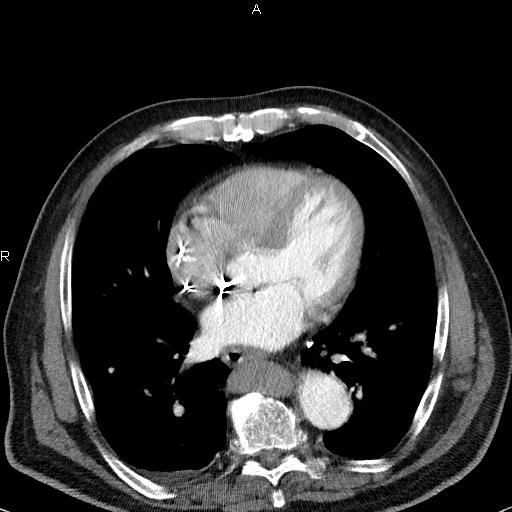 File:Azygos continuation of the inferior vena cava (Radiopaedia 18537-18404 C+ arterial phase 36).jpg