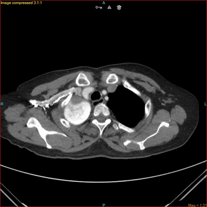Azygos vein aneurysm (Radiopaedia 77824-90130 B 11).jpg