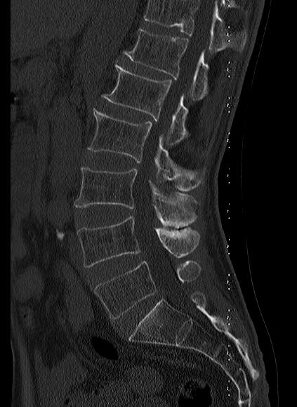 File:Baastrup syndrome (Radiopaedia 64891-73838 Sagittal bone window 9).jpg