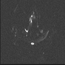 Balo concentric sclerosis (Radiopaedia 50458-55940 Axial DWI 69).jpg