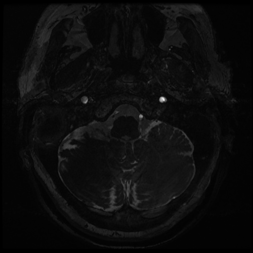 Balo concentric sclerosis (Radiopaedia 53875-59982 Axial T2 FIESTA 5).jpg