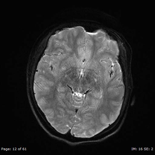 File:Balo concentric sclerosis (Radiopaedia 61637-69636 Axial DWI 12).jpg