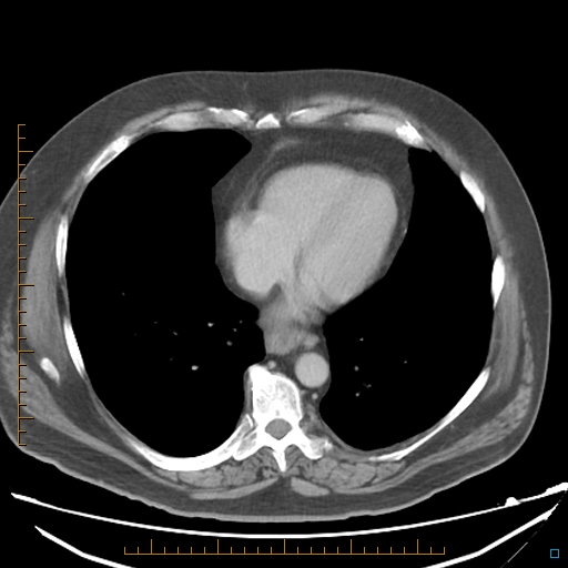 File:Bariatric balloon causing gastric outlet obstruction (Radiopaedia 54449-60672 A 3).jpg