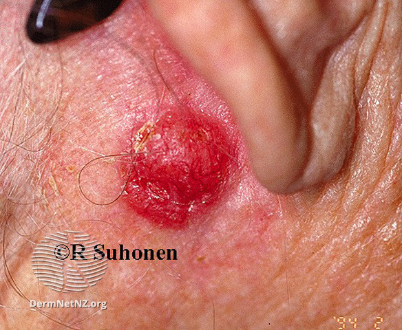 Basal cell carcinoma affecting the face (DermNet NZ lesions-bcc-face-0649).jpg