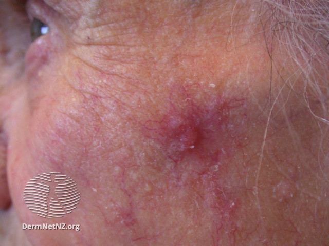 Basal cell carcinoma affecting the face (DermNet NZ lesions-bcc-face-1234).jpg