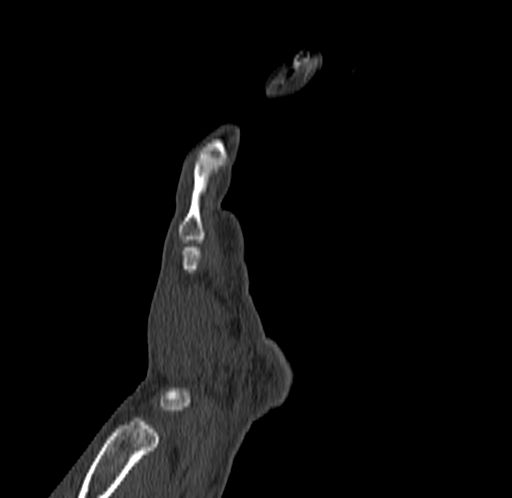 Base of 2nd metacarpal fracture (Radiopaedia 73741-84544 Coronal bone window 20).jpg
