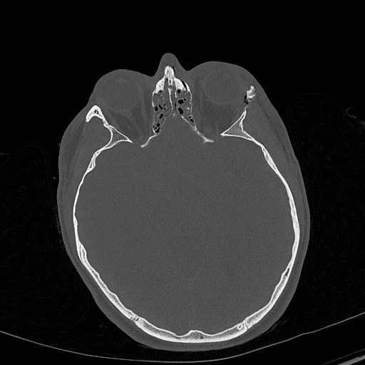 File:Base of skull fracture with bilateral Le Fort fractures (Radiopaedia 47094-51638 Axial bone window 43).jpg