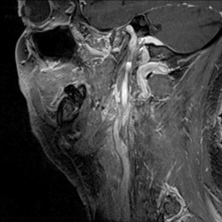 Base of tongue squamous cell carcinoma (Radiopaedia 31174-31884 F 51).jpg