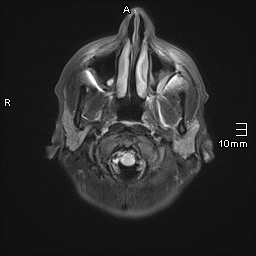 File:Basilar artery perforator aneurysm (Radiopaedia 82455-99523 Axial FLAIR 2).jpg
