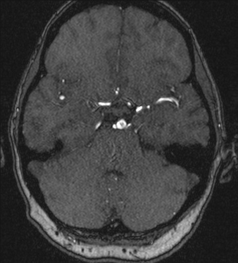 File:Basilar tip aneurysm (Radiopaedia 26504-26632 MRA 74).jpg