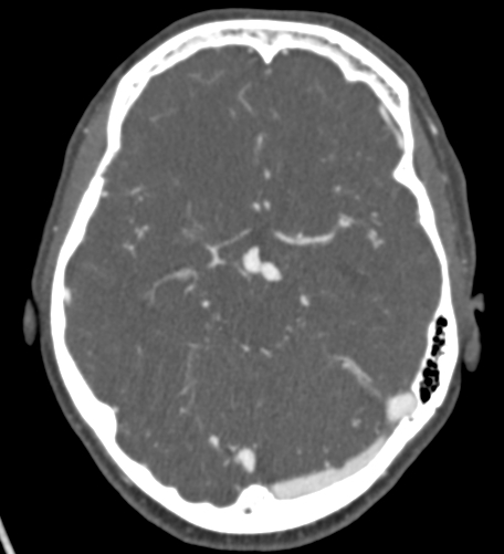 Basilar tip aneurysm with coiling (Radiopaedia 53912-60086 A 61).jpg