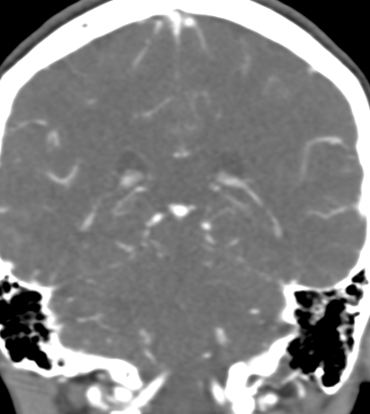 File:Basilar tip aneurysm with coiling (Radiopaedia 53912-60086 B 101).jpg