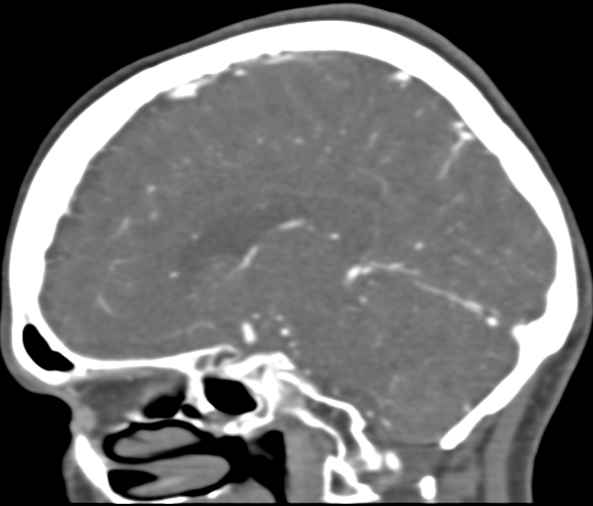 Basilar tip aneurysm with coiling (Radiopaedia 53912-60086 C 76).jpg