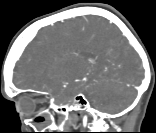 Basilar tip aneurysm with coiling (Radiopaedia 53912-60086 C 86).jpg