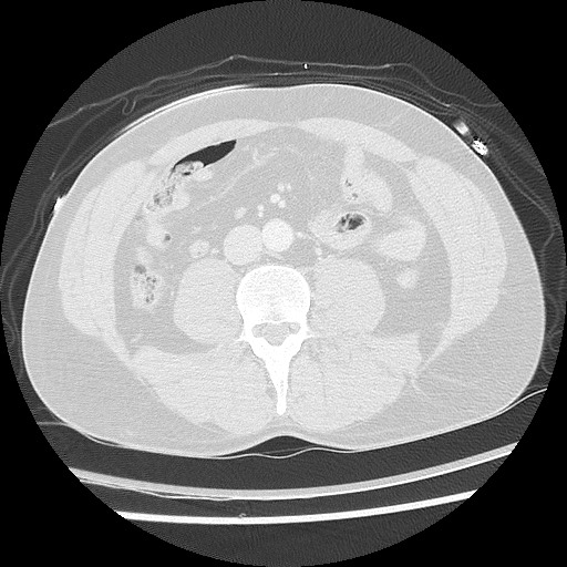 Benign post-traumatic pseudopneumoperitoneum (Radiopaedia 71199-81495 Axial lung window 97).jpg
