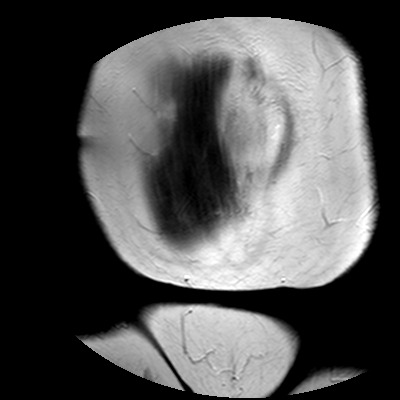 File:Benign seromucinous cystadenoma of the ovary (Radiopaedia 71065-81300 F 2).jpg