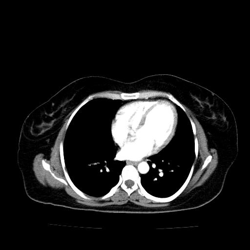 Benign spindle cell tumor - abdominopelvic (Radiopaedia 61300-69212 A 3).jpg