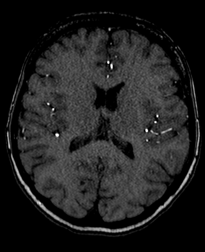 Berry aneurysm of the terminal internal carotid artery (Radiopaedia 88286-104918 Axial TOF 141).jpg