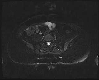 File:Bicornuate bicollis uterus (Radiopaedia 61626-69616 Axial PD fat sat 1).jpg