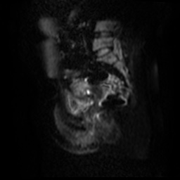 File:Bicornuate uterus (Radiopaedia 51676-57472 Sagittal DWI 13).jpg