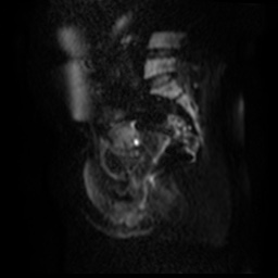 File:Bicornuate uterus (Radiopaedia 51676-57472 Sagittal DWI 38).jpg
