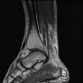 File:Bilateral Achilles tendon complete tear (Radiopaedia 81344-95051 Sagittal T1 12).jpg