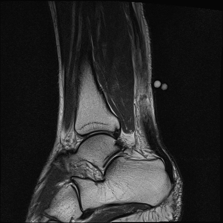 File:Bilateral Achilles tendon complete tear (Radiopaedia 81344-95051 Sagittal T2 25).jpg