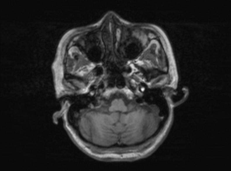 Bilateral PCA territory infarction - different ages (Radiopaedia 46200-51784 Axial T1 320).jpg
